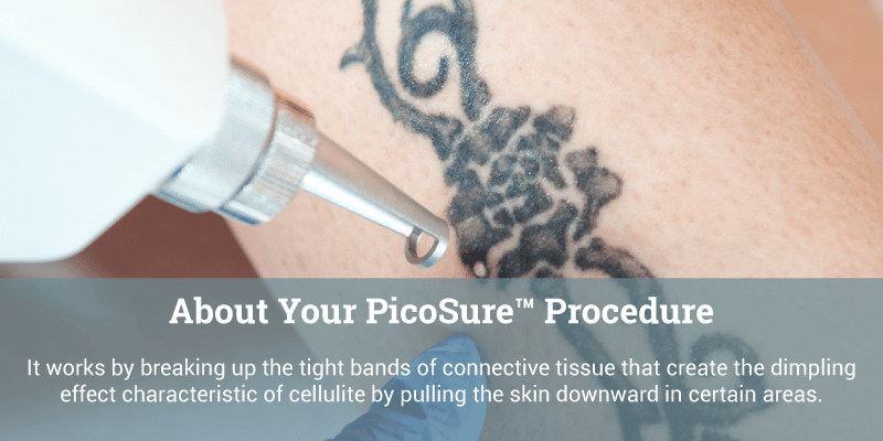 Tattoo Removal with PicoSure