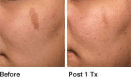 Birth Mark removal before and after