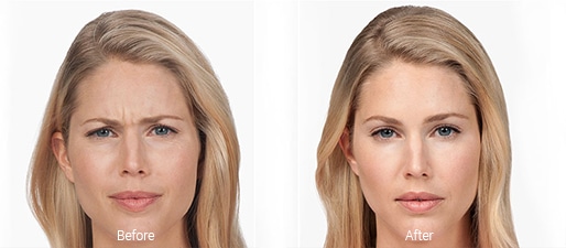 Botox before and after photos