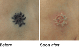 Tattoo Before and After in new york city