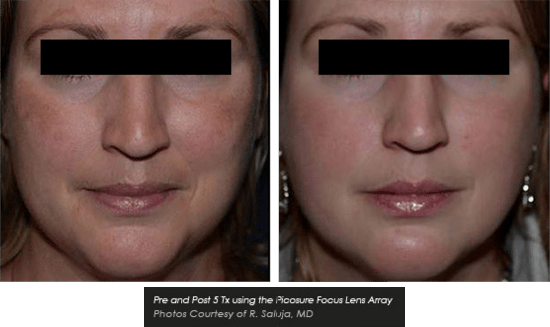 PicoSure Focus Before and after