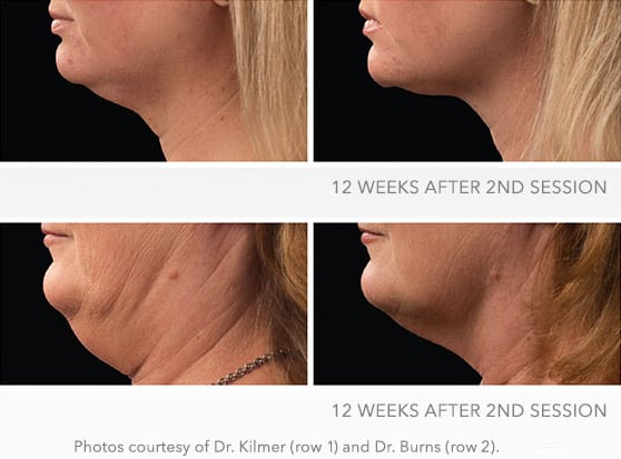 Coolsculpting Cool Mini before and after