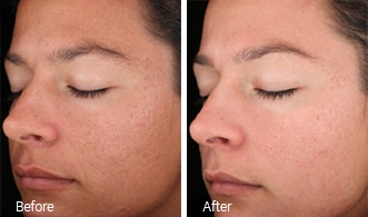 revitalize peel before and after
