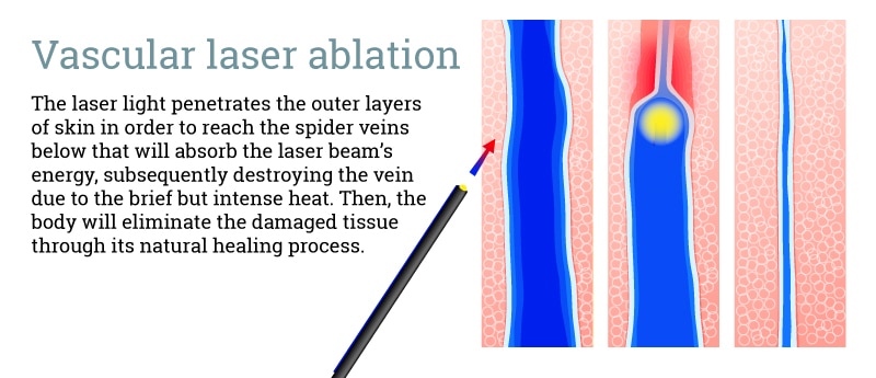 vascular-laser-