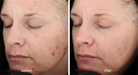 Vitalize peel before and after