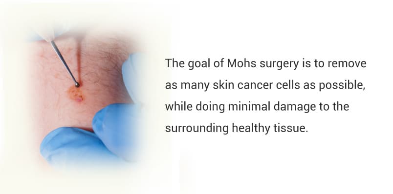 Mohs-surgery