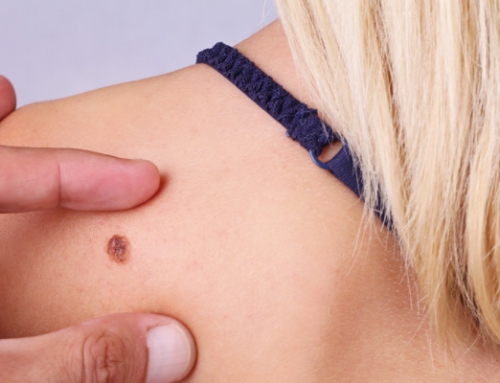 Follow These Top 5 Recommendations to Reduce Your Risk of Skin Cancer