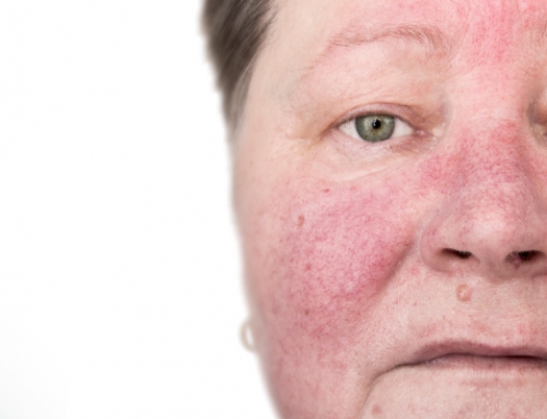 Tips to Manage Rosacea Symptoms
