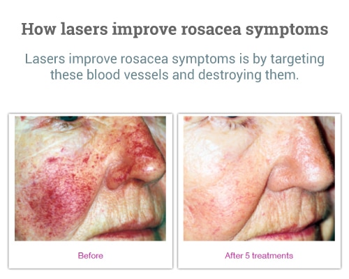 How-lasers-improve-rosacea-symptoms