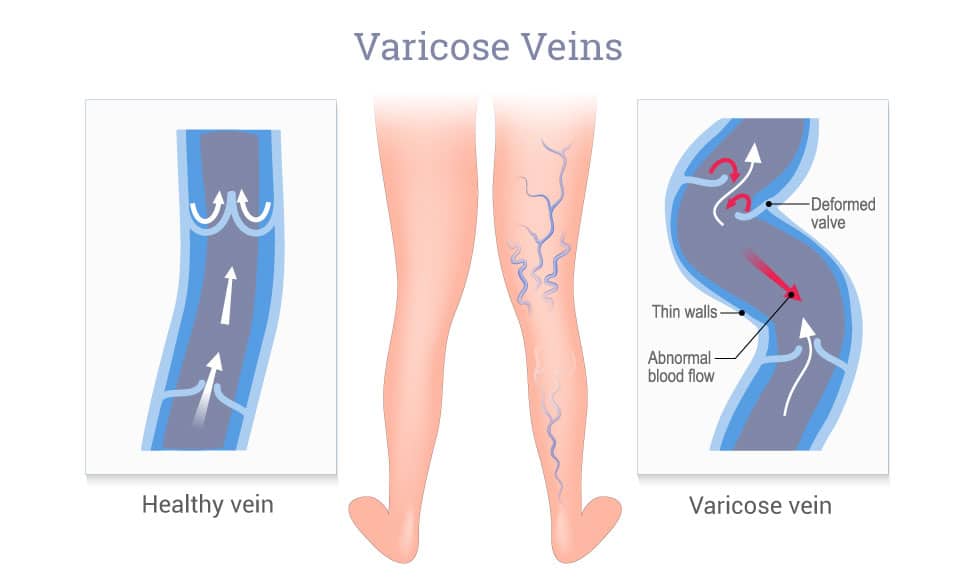 Varicose-veins