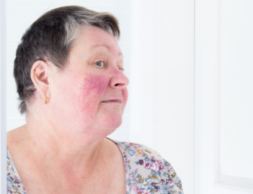 Why Lasers Are the Best Way to Treat Rosacea Symptoms