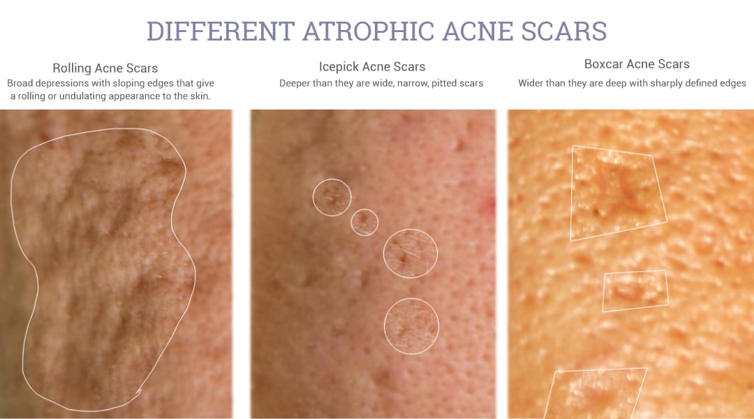 Atrophic Acne Scars