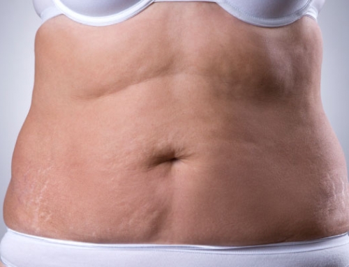 Do You Have Sagging Skin after Bariatric Surgery? Read This