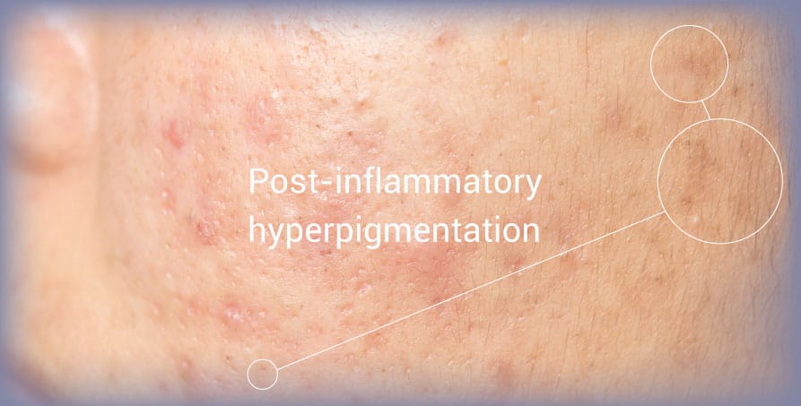 Post-Inflammatory Hyperpigmentation (PIH) on the Skin