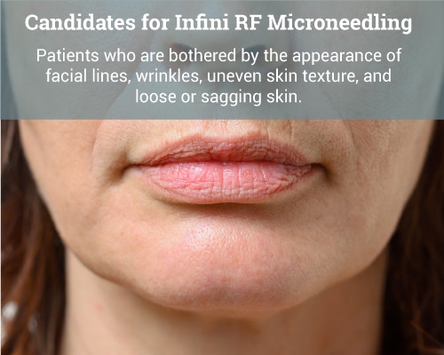 Candidates-for-Infini-RF-Microneedling