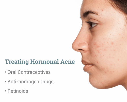 Treating-Hormonal-Acne