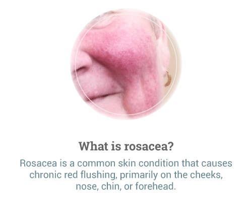 What-is-rosacea-