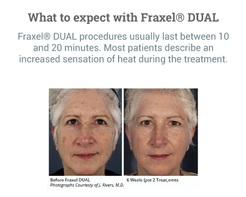 What-to-expect-with-Fraxel®-DUAL