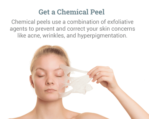 Get-a-Chemical-Peel-