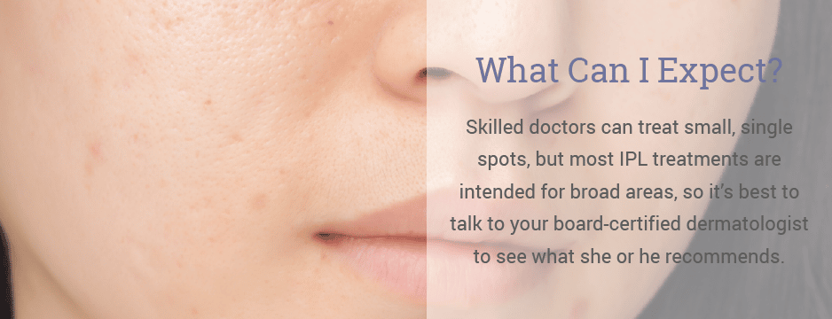 Skilled doctors can treat small, single spots, but most IPL treatments are intended for broad areas, so it’s best to talk to your board-certified dermatologist to see what she or he recommends.