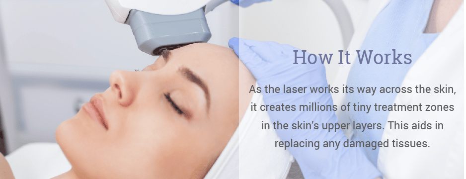 As the laser works its way across the skin, it creates millions of tiny treatment zones in the skin’s upper layers. This aids in replacing any damaged tissues