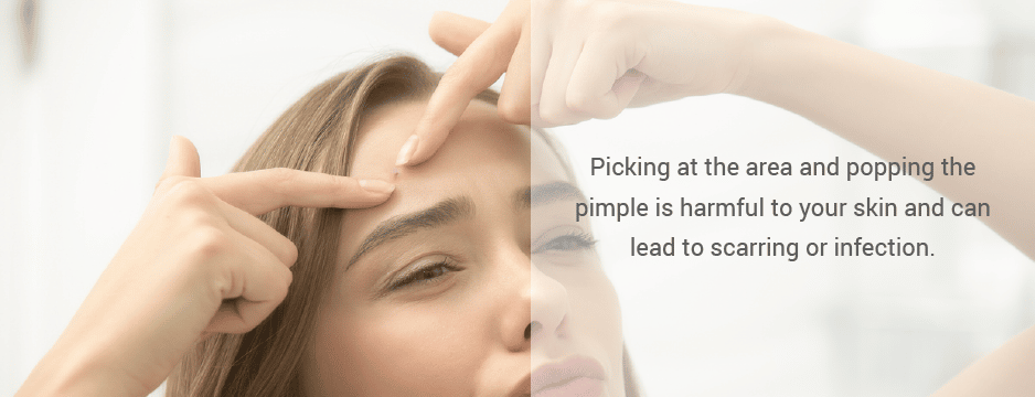 Picking at the area and popping the pimple is harmful to your skin and can lead to scarring or infection.