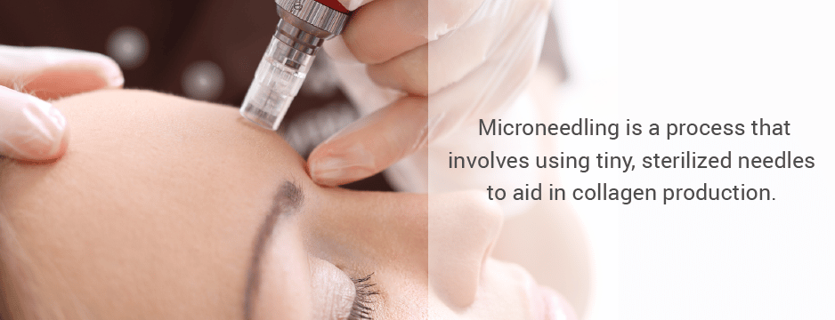 Microneedling is a process that involves using tiny, sterilized needles to aid in collagen production. 