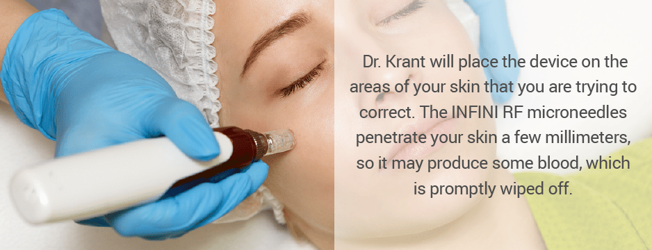 Dr. Krant will place the device on the areas of your skin that you are trying to correct. The INFINI RF microneedles penetrate your skin a few millimeters, so it may produce some blood, which is promptly wiped off.