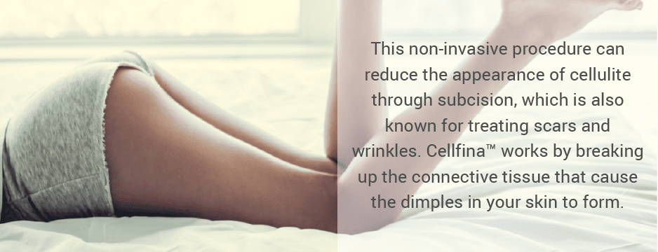 This procedure can reduce the appearance of cellulite through controlled-depth subcision, which is also known for treating scars and wrinkles. Cellfina™ works by breaking up the connective tissue that causes the dimples in your skin to form.