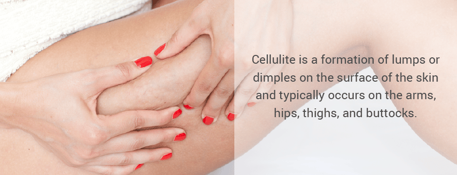 Cellulite is a formation of lumps or dimples on the surface of the skin and typically occurs on the arms, hips, thighs, and buttocks.