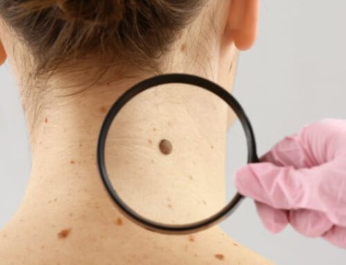 The Importance of Skin Cancer Screenings