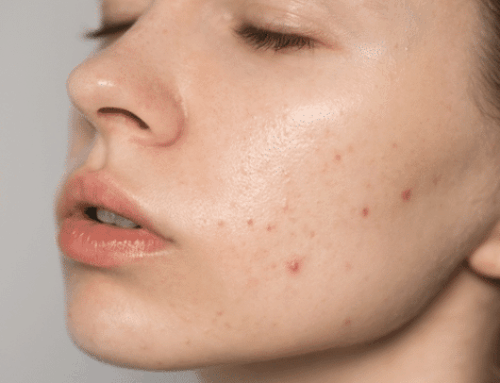 Back to School Skincare: Acne Treatments in NYC