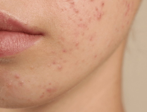 Effective Acne Scar Treatment Options in NYC