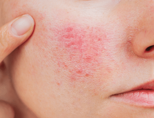 Rosacea Treatment: Your Questions Answered